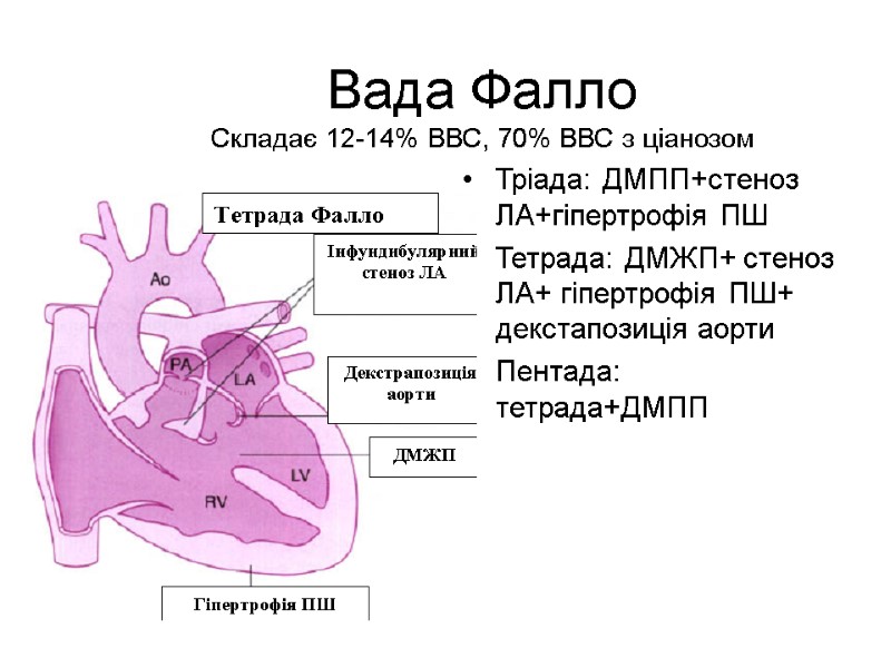 Вада Фалло Складає 12-14% ВВС, 70% ВВС з ціанозом Тріада: ДМПП+стеноз ЛА+гіпертрофія ПШ Тетрада: